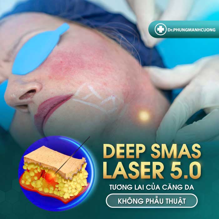 Deep Smas Laser 5.0 - Công nghệ trẻ hóa thế hệ mới